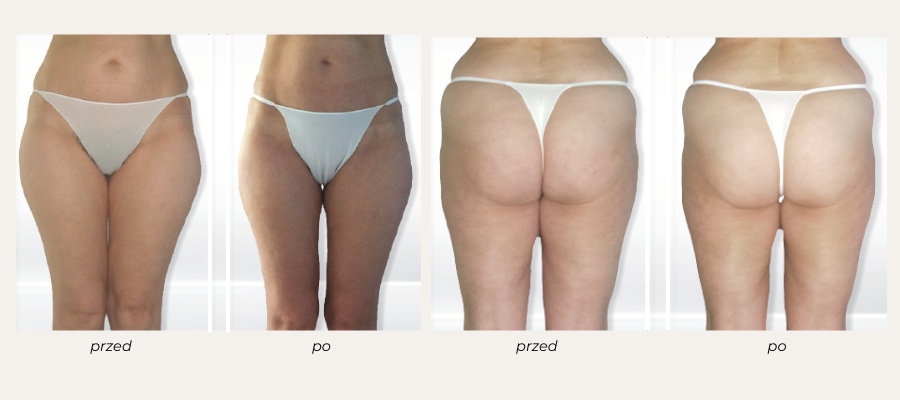 endermologia lpg Bella Clinica Gdańsk