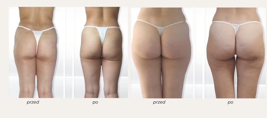 endermologia bella clinica gdansk