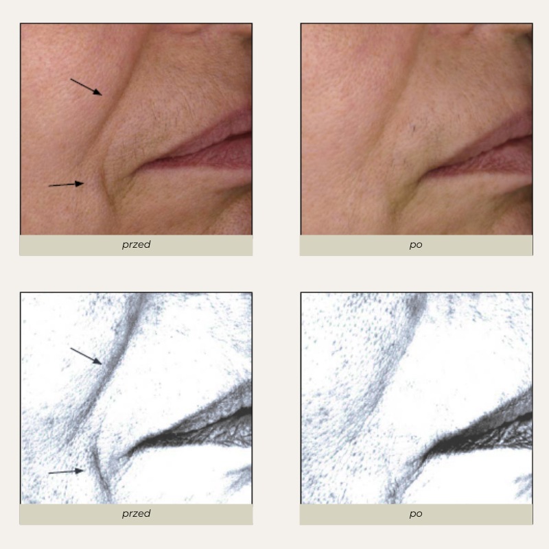endermolift endermologia twarzy