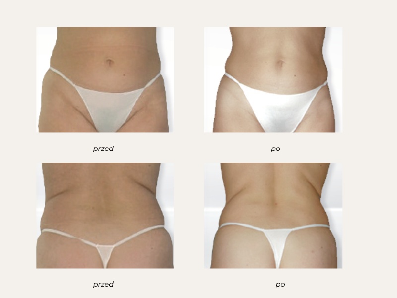 endermologia lpg efekty